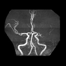 左侧大脑后动脉开窗畸形图片,脑部基底动脉开窗畸形如何治疗