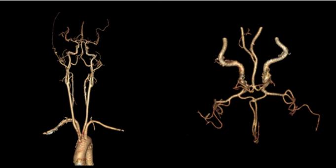 左侧大脑后动脉开窗畸形图片,脑部基底动脉开窗畸形如何治疗