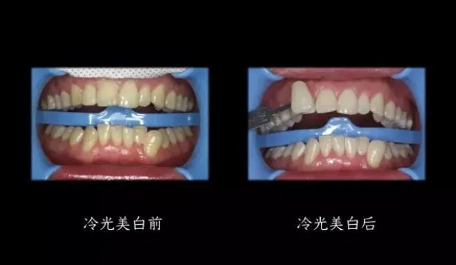 牙科医生教你牙齿美白,牙齿黄渍刷不干净老牙医教你一招