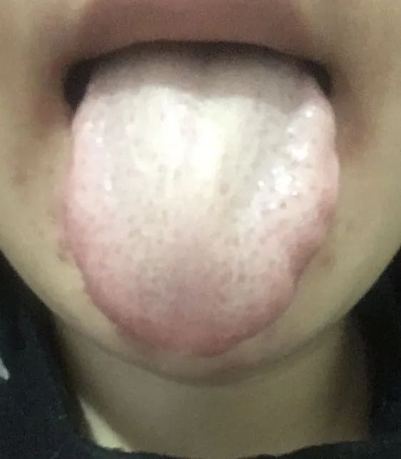 红豆薏米祛湿气真有效吗,红豆薏米去湿气推荐