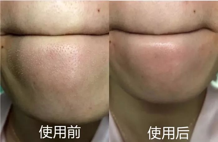 用什么洗脸抑制螨虫生长,用什么洗脸可以抑制螨虫生长