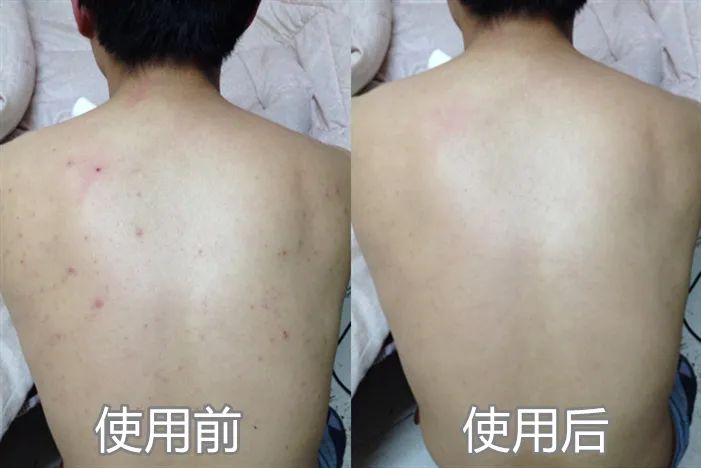 啤酒消痘痘,喝啤酒会消除痘痘吗