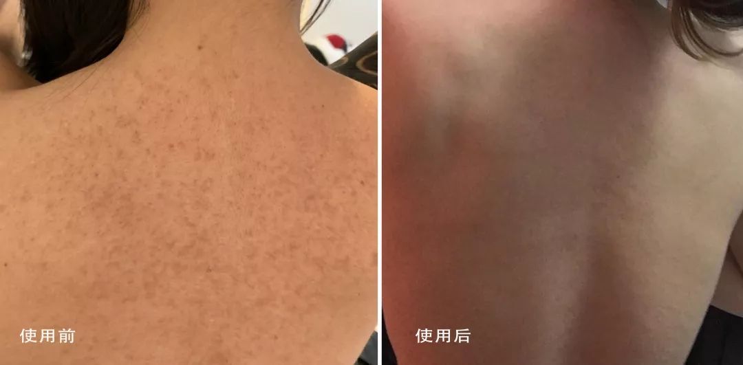 别放弃，烦人的“鸡皮疙瘩”，真的还可以再救一下