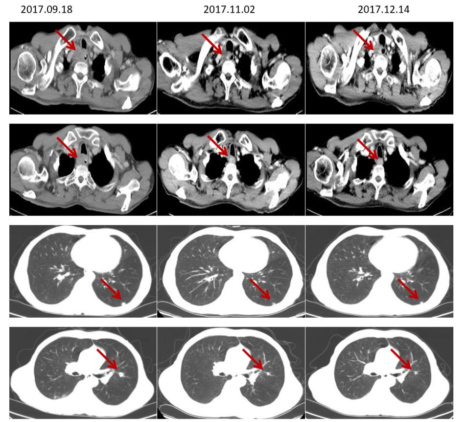 食管癌樊青霞,樊青霞讲食道癌