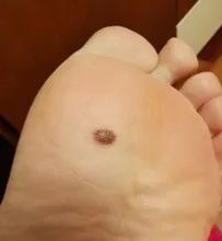 注意|这几天上万网友在身上找痣！知名医生：长在这些地方的特别留意！
