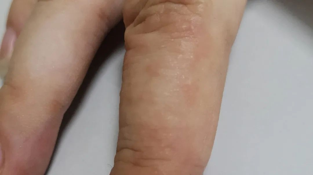 长痒痒的小水泡可以挤吗,小水泡很痒怎么快速止痒