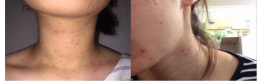 挤痘痘出来的白色长条状是什么,痘痘黑头挤出白颗粒