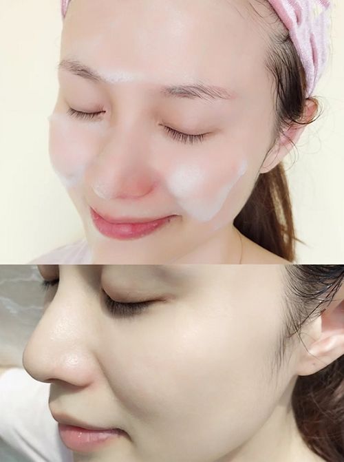 挤痘痘出来的白色长条状是什么,痘痘黑头挤出白颗粒