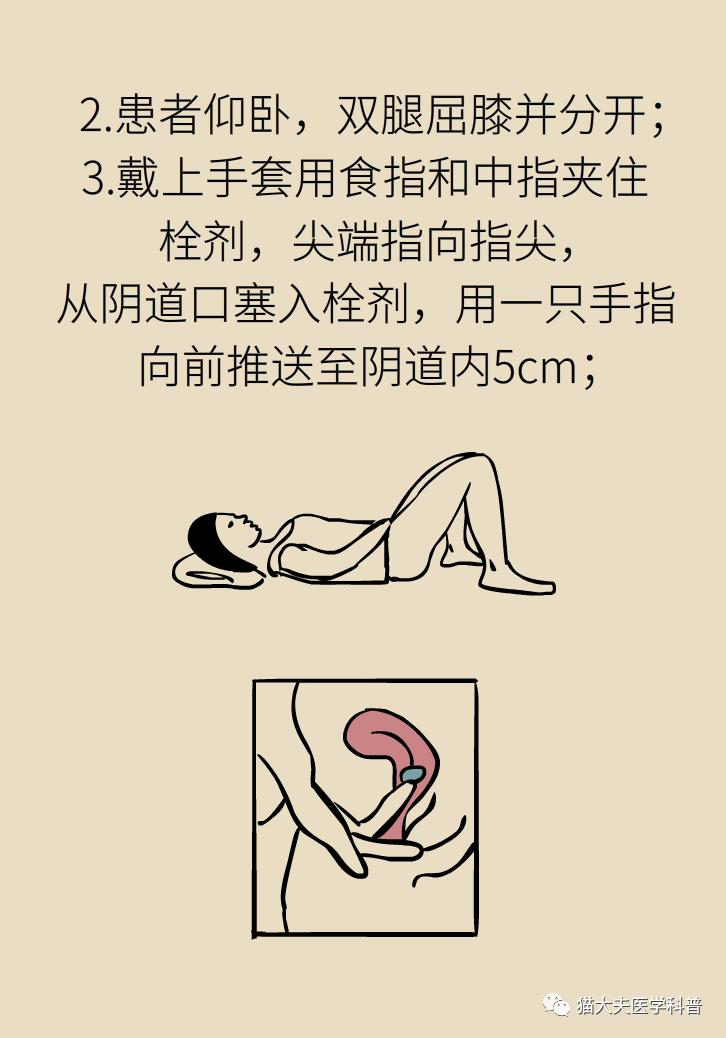 霉菌性阴道炎真的是里面“发霉”了吗？药师教你“抗霉”*法大**