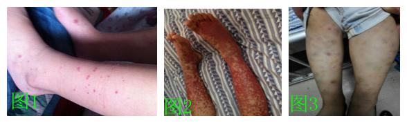 婴儿皮肤一碰就肿,为什么婴儿皮肤一碰就肿了