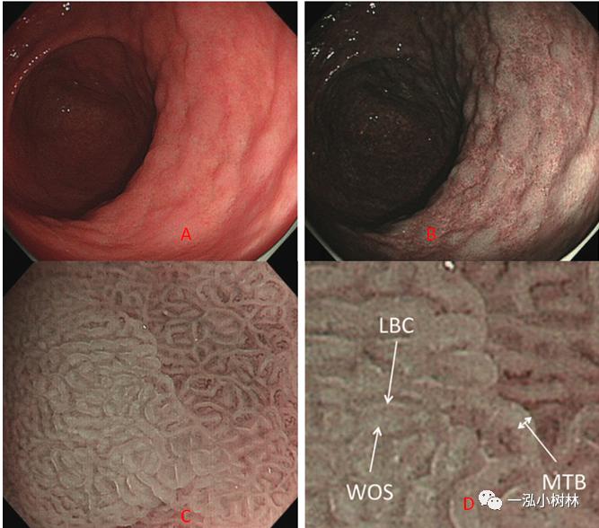 肠上皮化生做什么检查,肠化生内镜看得出来吗