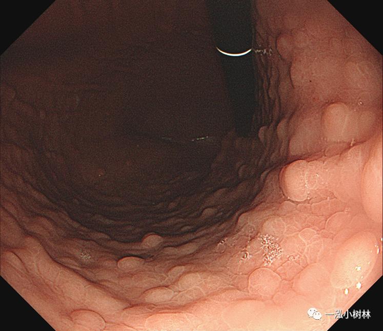 肠上皮化生做什么检查,肠化生内镜看得出来吗