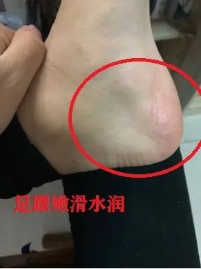 一招告别死皮老茧脚,去脚后跟老茧死皮的法子