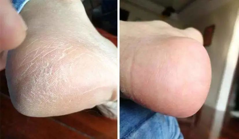 一招告别死皮老茧脚,去脚后跟老茧死皮的法子