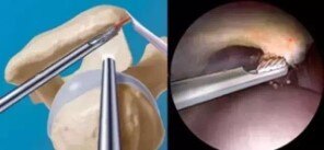 拯救肩颈,肩峰下撞击综合征最好的治疗方法