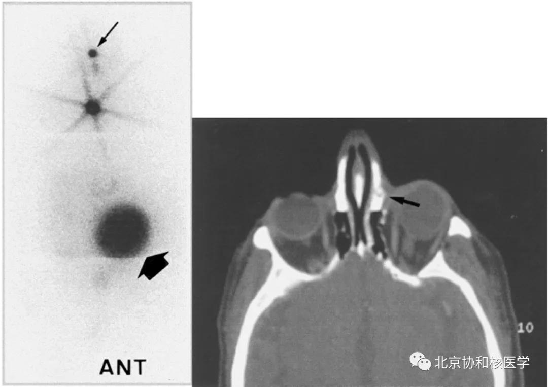 碘扫描最坏的结果,放射性核素扫描可以鉴别诊断吗
