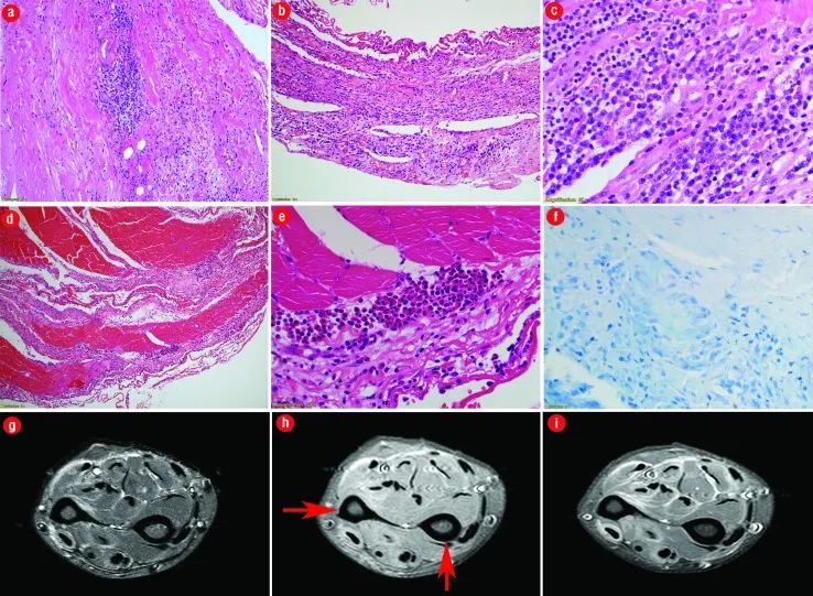 双前臂远端肿胀,女性手胳膊肿胀图片