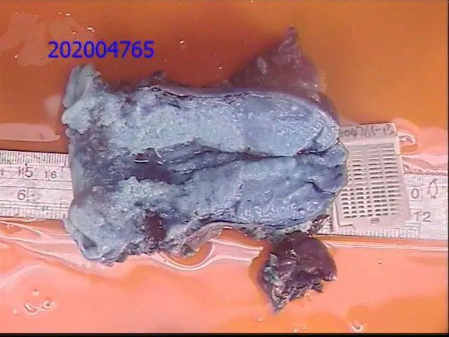 【关注】“为什么是我？！”广东一女子乳腺癌刚痊愈，又发现患上宫颈癌……