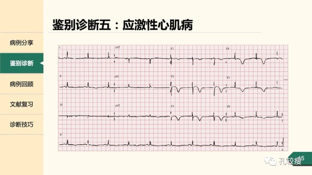 t波倒置在心电图中怎么看,T波低平心电图讲解