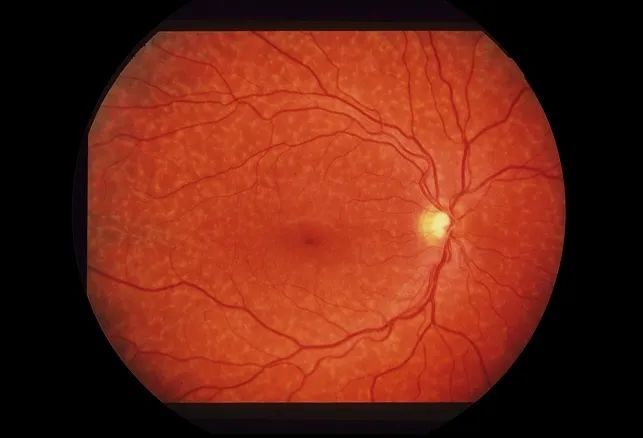 早发性黄斑变性,干性老年性黄斑变性简称