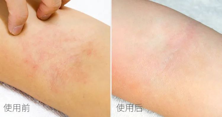 三伏天艾草熏后背多久熏一次,三伏天用艾草泡澡几天泡一次