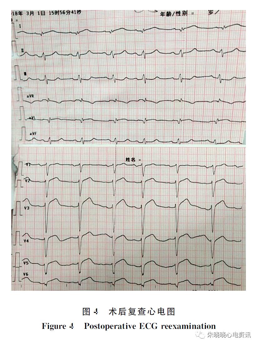 漏诊dewinter综合征,dewinter综合征相关心电图特点