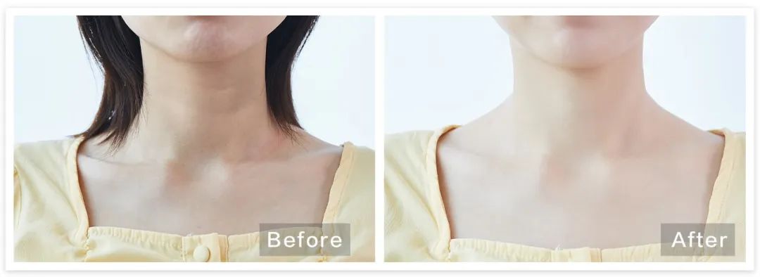 女人脖子有颈纹和年龄有关吗,一条颈纹代表二十岁