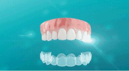 昆明龅牙矫正哪家便宜,长沙成人隐形牙齿矫正龅牙