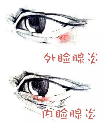 眼皮长了小疙瘩自己掐下来了,眼皮上长了个小肉粒是疣吗