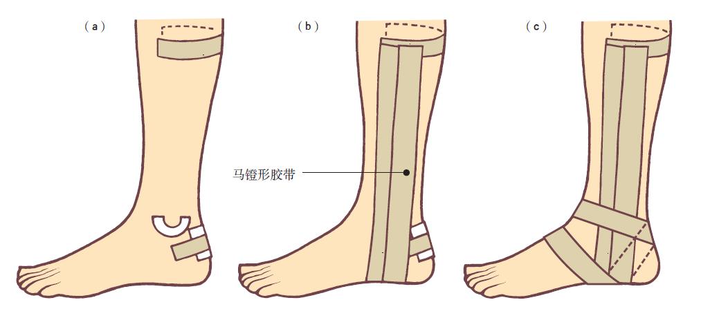 踝关节损伤的处理7条助你应对,踝关节损伤恢复的阶段表现发痒