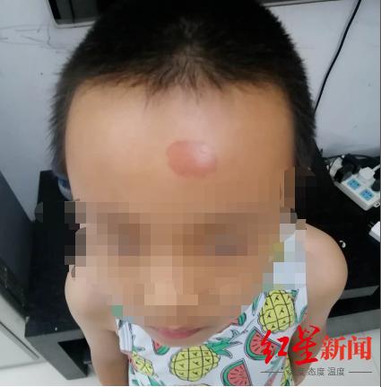 学校紫外线灼伤事件,一小学生误开紫外线灯5小时