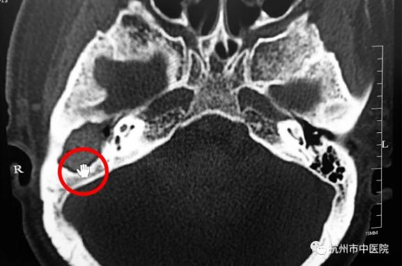 男子掏耳朵掏出黑色虫子,小伙掏耳朵掏出大秘密