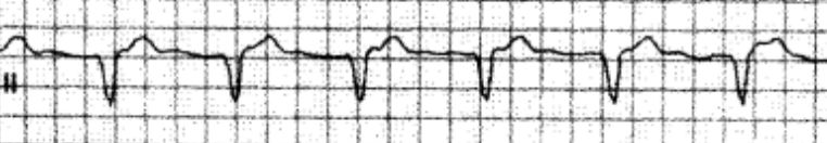 室速属于重大疾病吗,室速的相关资料