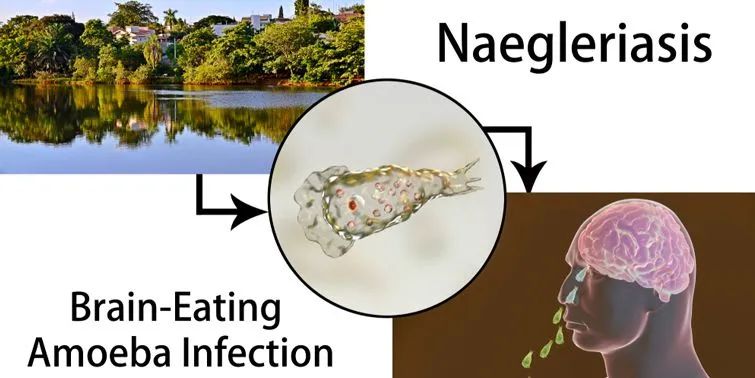 游泳得脑膜炎,游泳发烧会引起脑损伤吗