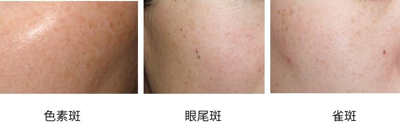 去斑点最有效方法医美去除斑痕,脸上暗沉有斑点可以做什么医美