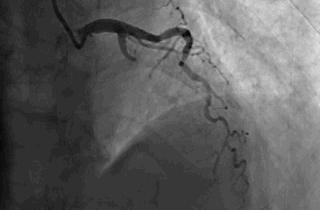 34岁北大博士心梗猝死,国世平老师突发心梗