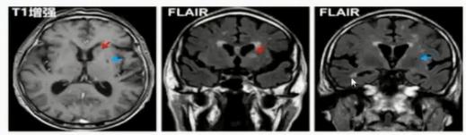 徐运神经内科,徐运医生怎么样