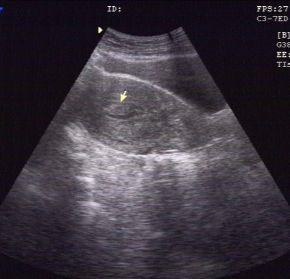 内膜息肉切除后多久怀孕最佳,宫腔内膜中有小息肉会影响怀孕吗