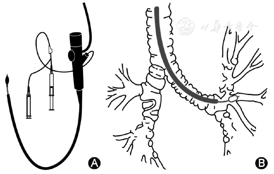 icu患者肺栓塞应急预案演练脚本,肺泡灌洗液标本标准