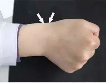 手腕劳累过度疼痛怎么治疗最快,手腕过度劳累疼痛怎么治疗最快