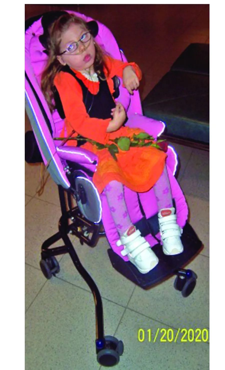 GNAO1基因变异导致的早发性癫痫脑病