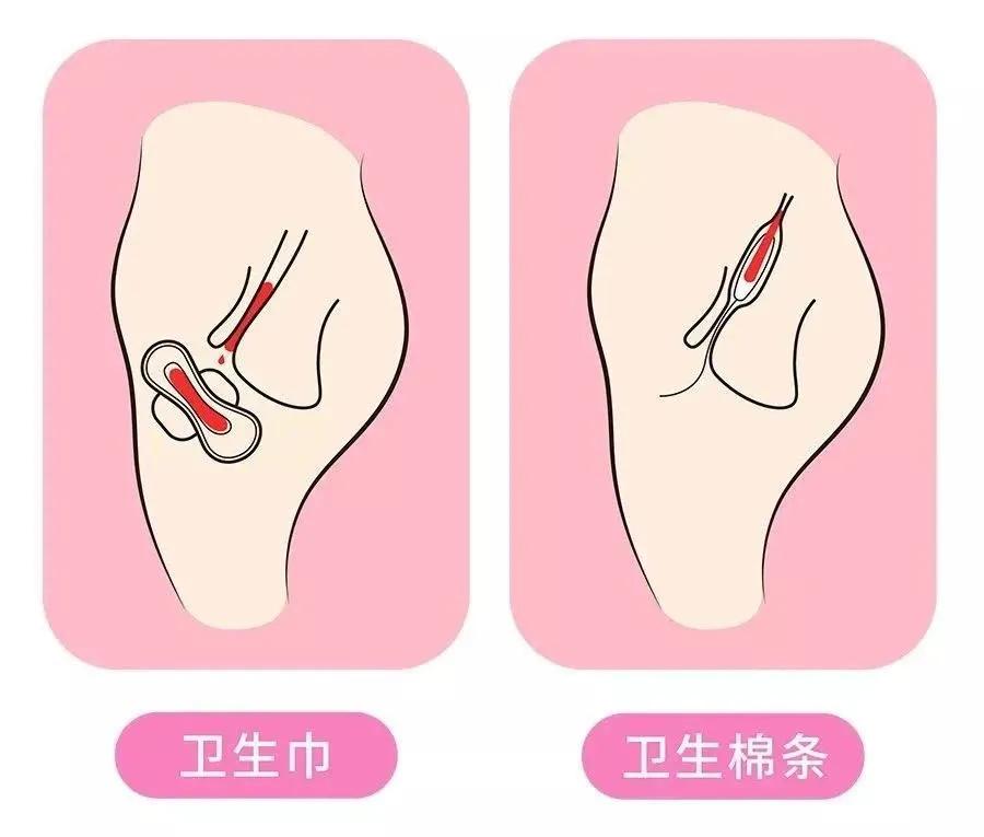 经期侧漏最好的解决办法,月经太多总是侧漏怎么办