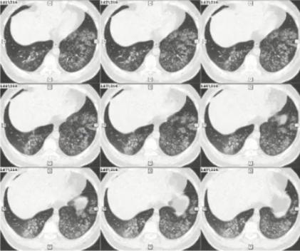 支原体肺炎症状应该注意什么,支原体肺炎这些症状要警惕