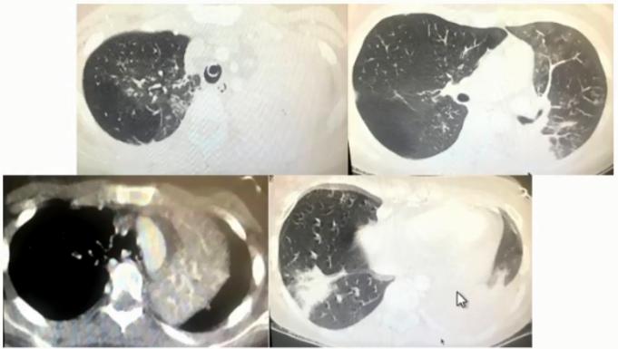 支原体肺炎症状中医诊治,成人肺炎支原体肺炎诊治专家共识