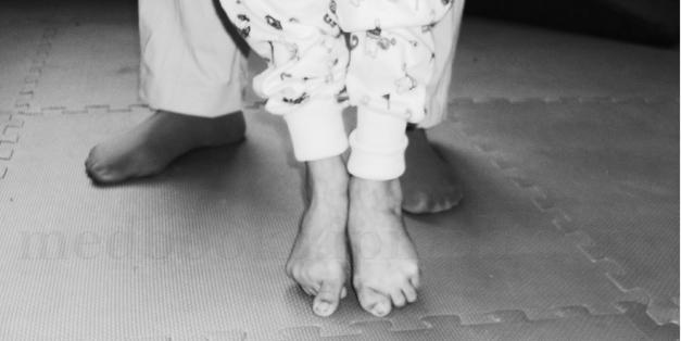 婴幼儿脑瘫早期发现和早期治疗直接影响今后生活质量