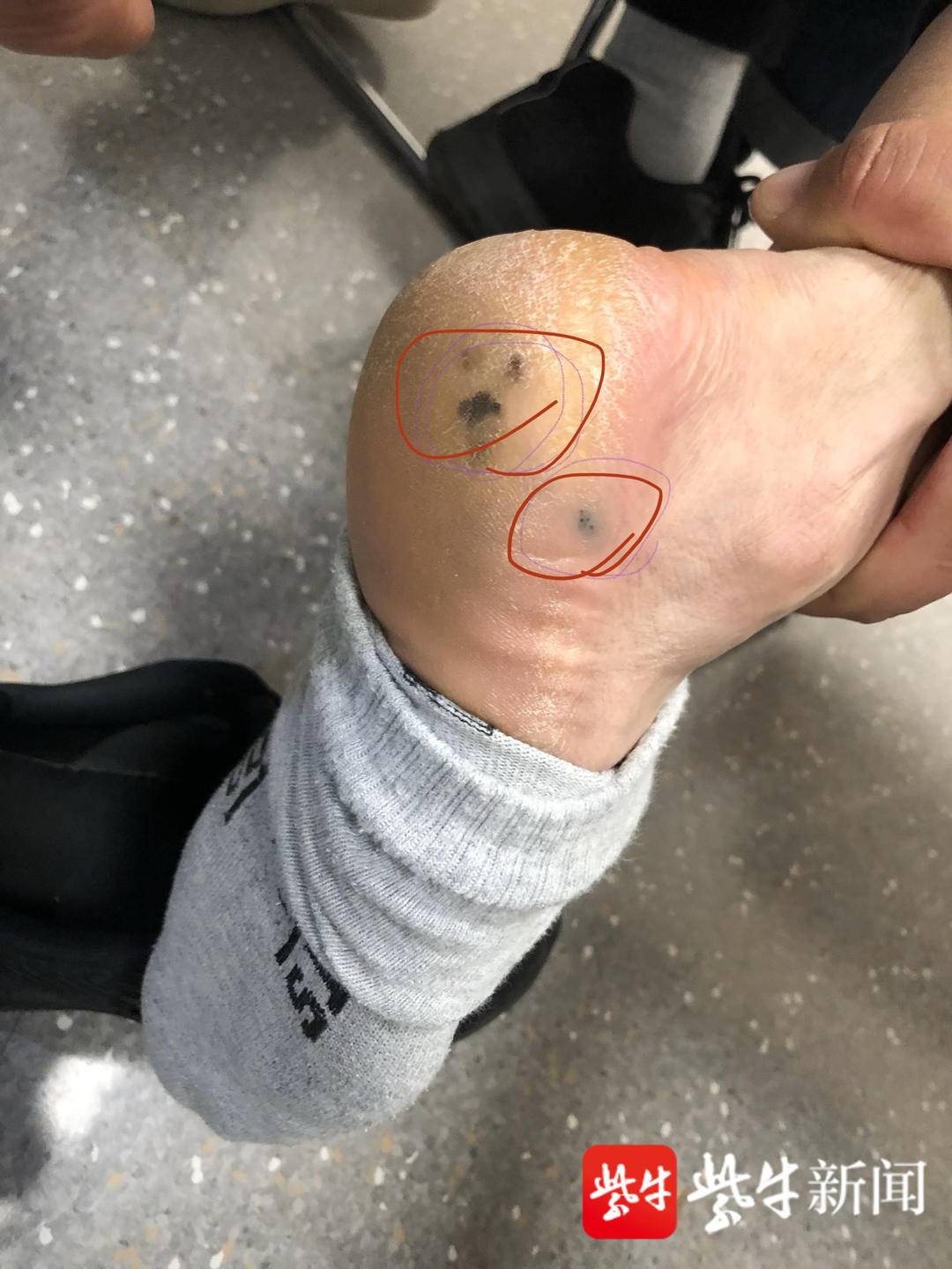 脚后跟黑痣去哪里治疗,脚后跟长个黑痣发病过程