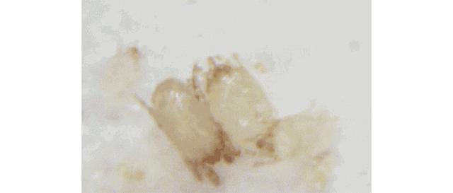 痘痘挤出的白米粒是什么,痘痘挤出来的白色乳浆是什么