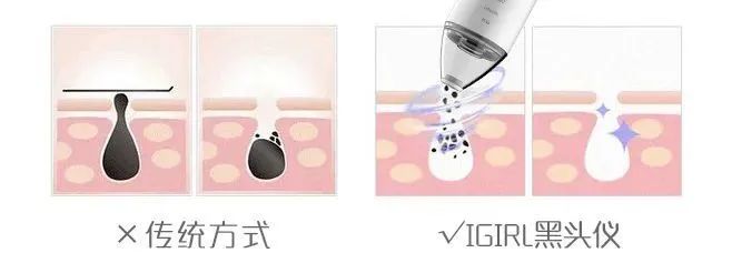 痘痘挤出的白米粒是什么,痘痘挤出来的白色乳浆是什么