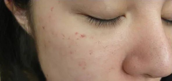 痘痘挤出的白米粒是什么,痘痘挤出来的白色乳浆是什么