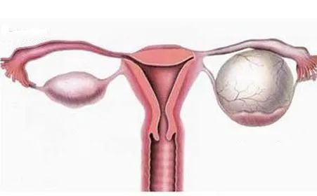 从“卵巢囊肿”到“卵巢癌”,究竟需要多久?
